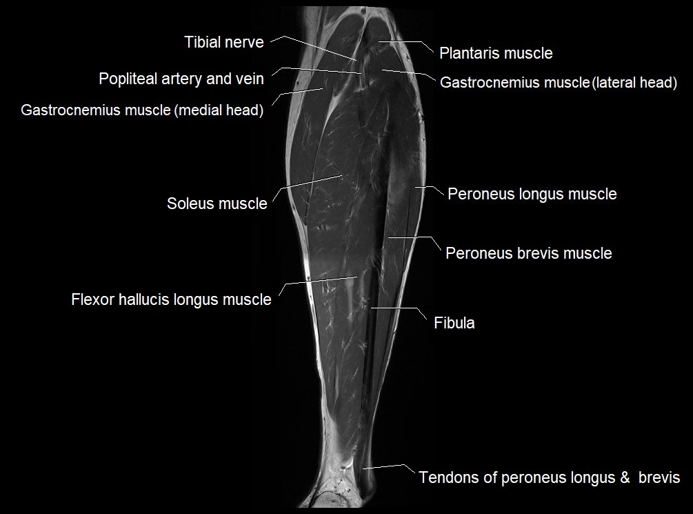 MRI 3T leg (tibia & fibula) labelled coronal cross sectional anatomy image 22.webp